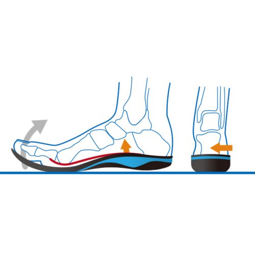 Ideal alignment by Windlass mechanism