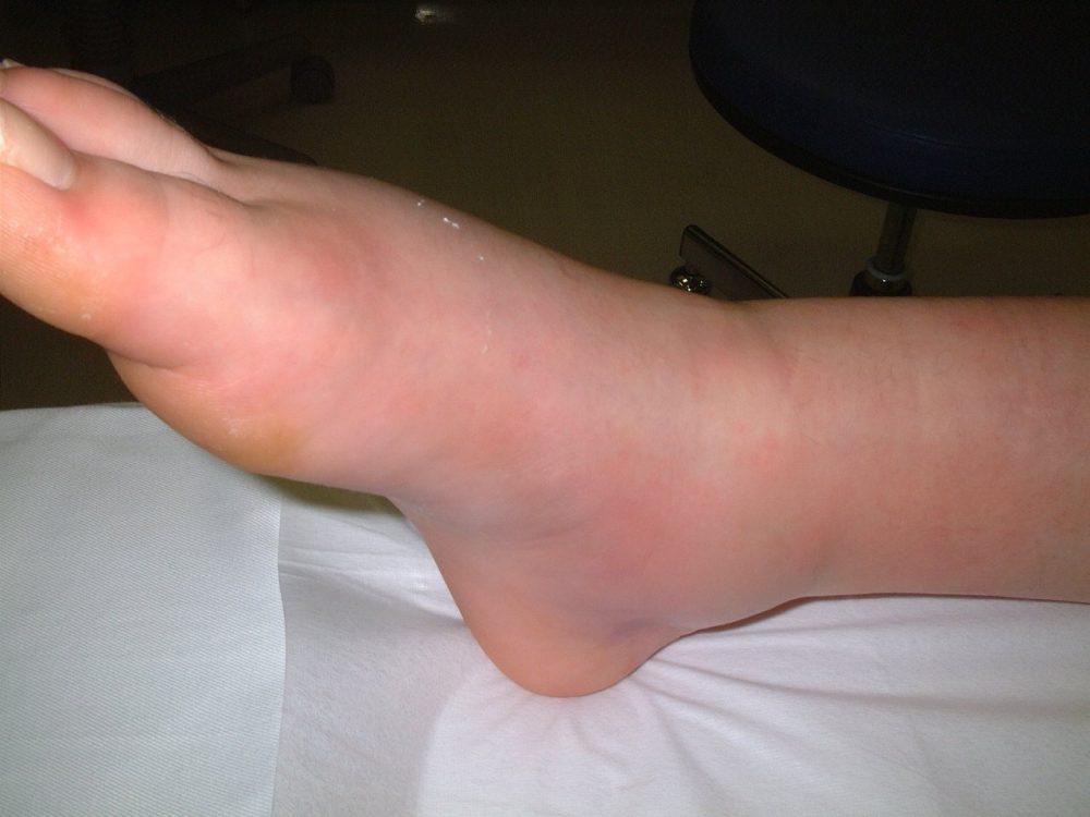 Varus sprain photograph 2