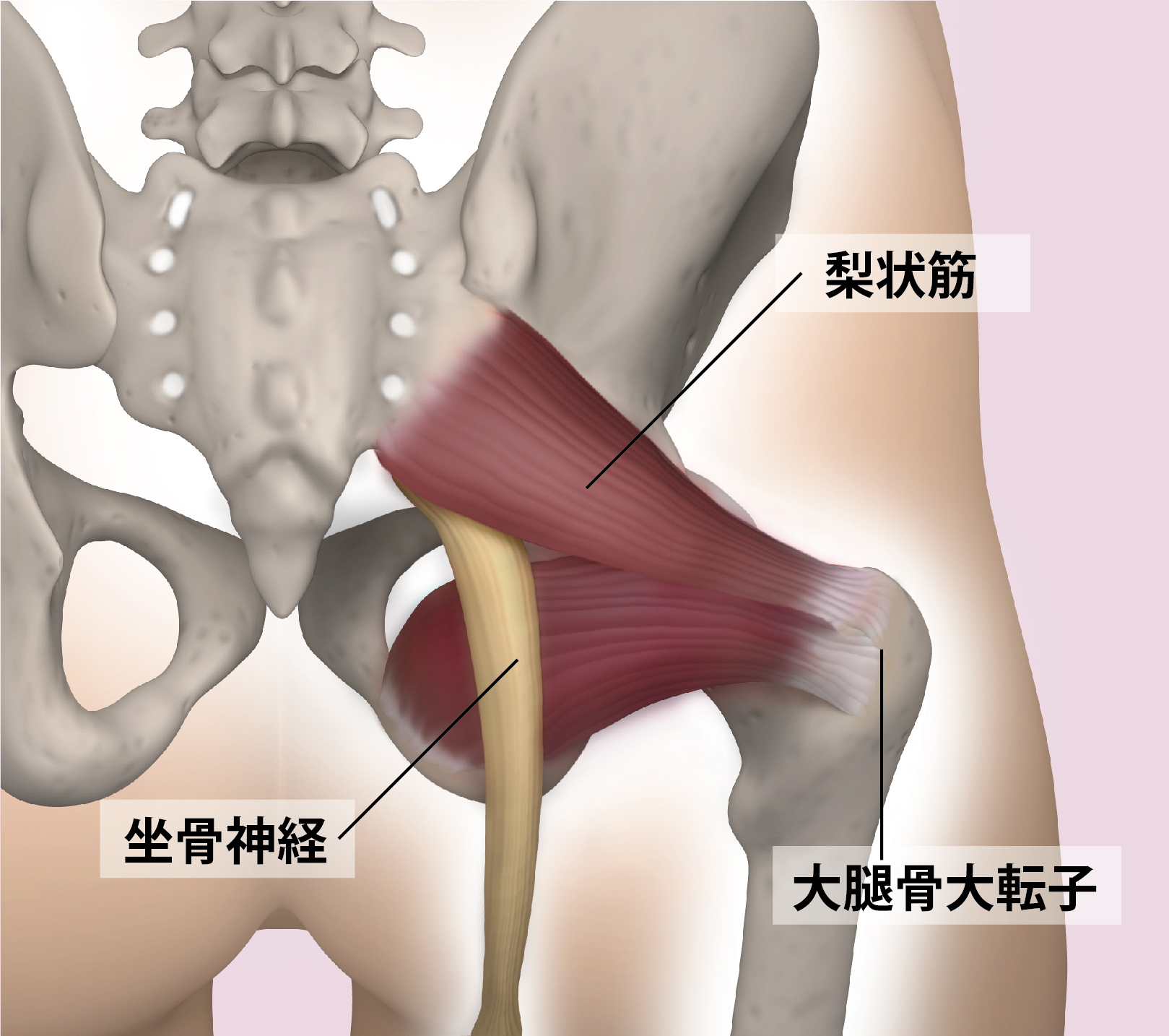 Piriformis Syndrome 1